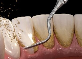 Penyebab Karang gigi