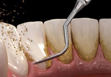 Penyebab Karang gigi