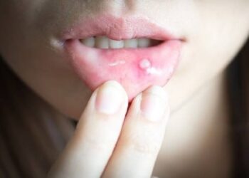 Penyebab, Gejala, Pengobatan, dan Pencegahan Sariawan pada Mulut