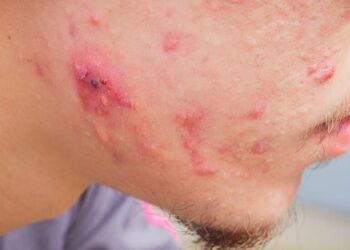 9 Cara Mengatasi Jerawat dengan Tepat -sehatq.com-