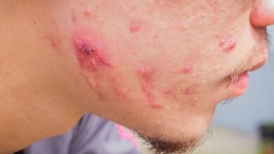 9 Cara Mengatasi Jerawat dengan Tepat -sehatq.com-