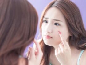 Jerawat Bukan Hanya Masalah Kecantikan, ada Dampak Fisik dan Psikologis