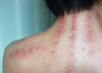 Kerokan, Tradisi Pengobatan Tradisional Indonesia