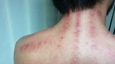 Kerokan, Tradisi Pengobatan Tradisional Indonesia