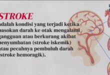 Mengenal Stroke Penyebab, Gejala, dan Pencegahannya