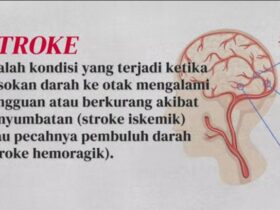 Mengenal Stroke Penyebab, Gejala, dan Pencegahannya