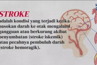 Mengenal Stroke Penyebab, Gejala, dan Pencegahannya