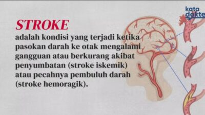 Mengenal Stroke: Penyebab, Gejala, dan Pencegahannya