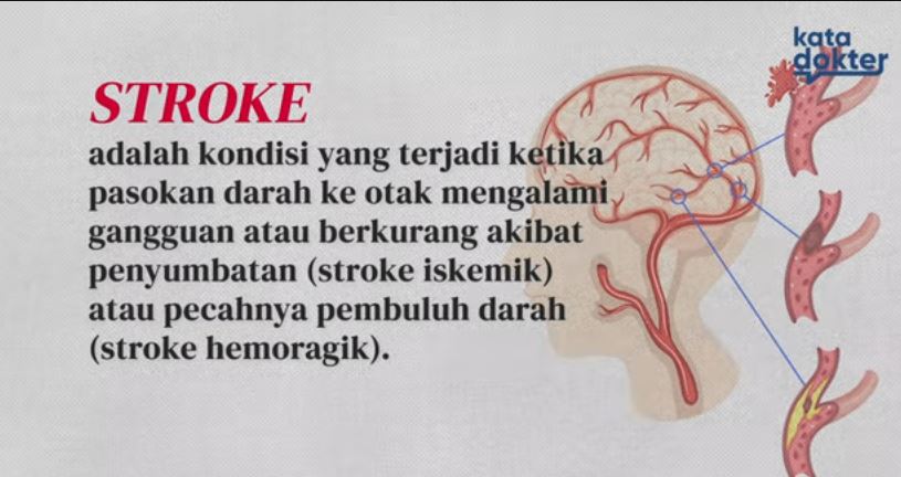 Mengenal Stroke Penyebab, Gejala, dan Pencegahannya